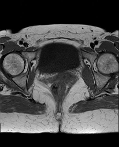 File:Adult granulosa cell tumor of the ovary (Radiopaedia 71581-81950 Axial T1 21).jpg