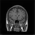 Amnestic syndrome secondary to hypoxic brain injury (Radiopaedia 24743-25004 B 18).jpg