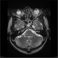 Amnestic syndrome secondary to hypoxic brain injury (Radiopaedia 24743-25004 T2 5).jpg