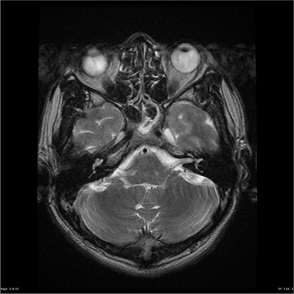 File:Amnestic syndrome secondary to hypoxic brain injury (Radiopaedia 24743-25004 T2 5).jpg