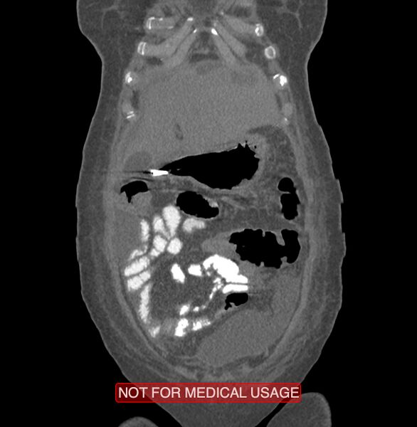 File:Amoebic enterocolitis with liver abscess (Radiopaedia 35100-36609 B 19).jpg