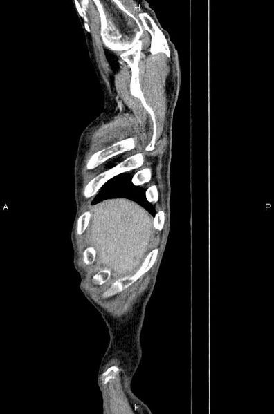 File:Ampullary adenocarcinoma (Radiopaedia 86093-102033 E 3).jpg