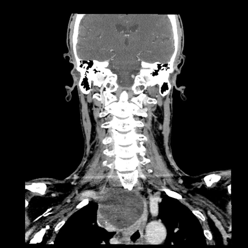 Anaplastic thyroid carcinoma (Radiopaedia 79087-92034 A 75).jpg