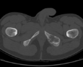 Aneurysmal bone cyst of ischium (Radiopaedia 25957-26094 Axial bone window 76).png