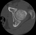 Aneurysmal bone cyst of ischium (Radiopaedia 25957-26094 B 14).png