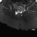 Ano-vaginal fistula (Radiopaedia 29765-30284 Coronal STIR 25).jpg
