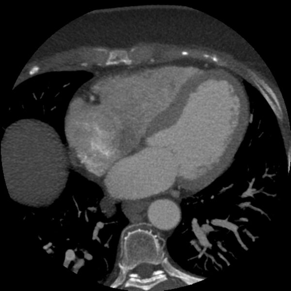 File:Anomalous origin of left circumflex artery from right coronary sinus (Radiopaedia 72563-83117 A 25).jpg