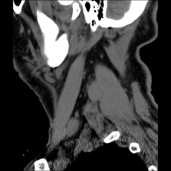 File:Anterior cervical postdiscectomy arthrodesis (Radiopaedia 32678-33646 C 45).jpg