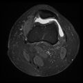 Anterior cruciate ligament tear, Wrisberg rip and bucket-handle tear of medial meniscus (Radiopaedia 75872-87266 Axial PD fat sat 22).jpg