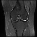 Anterior cruciate ligament tear, Wrisberg rip and bucket-handle tear of medial meniscus (Radiopaedia 75872-87266 Coronal PD fat sat 16).jpg
