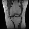 Anterior cruciate ligament tear, Wrisberg rip and bucket-handle tear of medial meniscus (Radiopaedia 75872-87266 Coronal T1 12).jpg