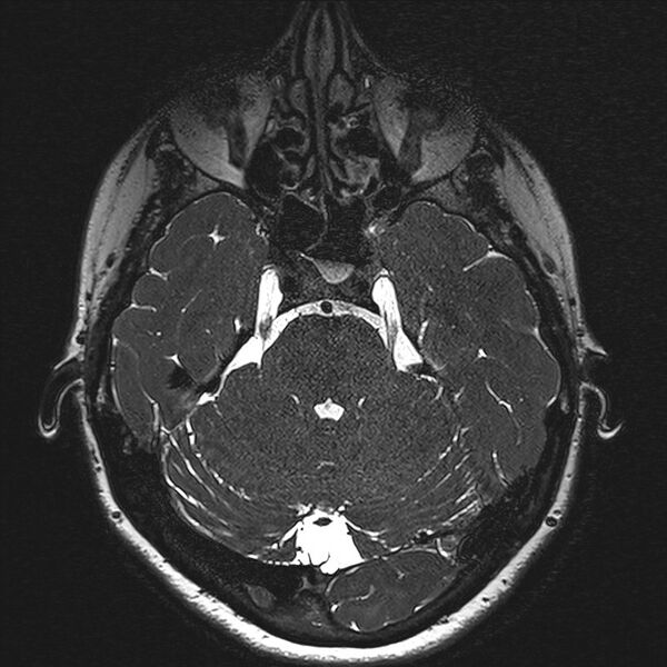 File:Anterior temporal encephalocele (Radiopaedia 82624-96808 Axial T2 high res 42).jpg