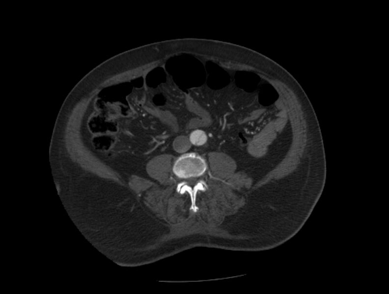 File:Aortic dissection (Radiopaedia 28802-29105 A 72).jpg