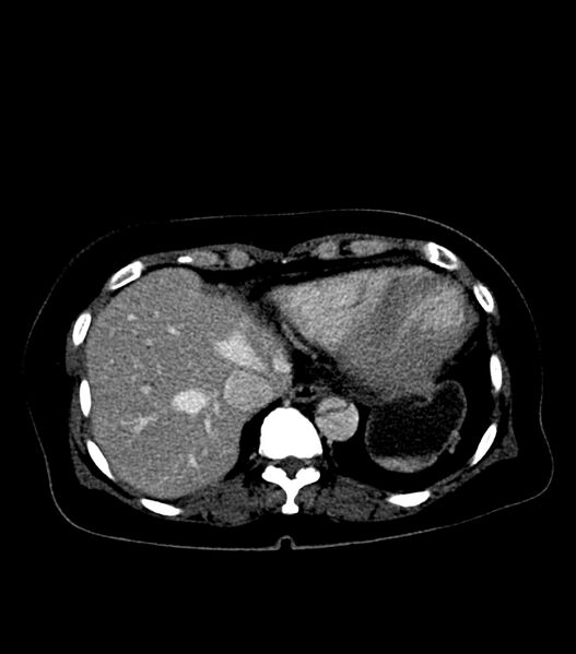 File:Aortic dissection with renal ischemia (Radiopaedia 76573-88338 B 21).jpg