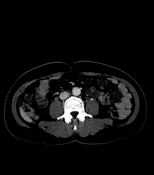 File:Aortic dissection with renal ischemia (Radiopaedia 76573-88338 B 46).jpg