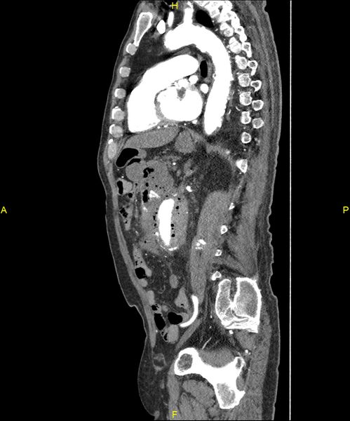 File:Aortoenteric fistula (Radiopaedia 84308-99603 C 208).jpg