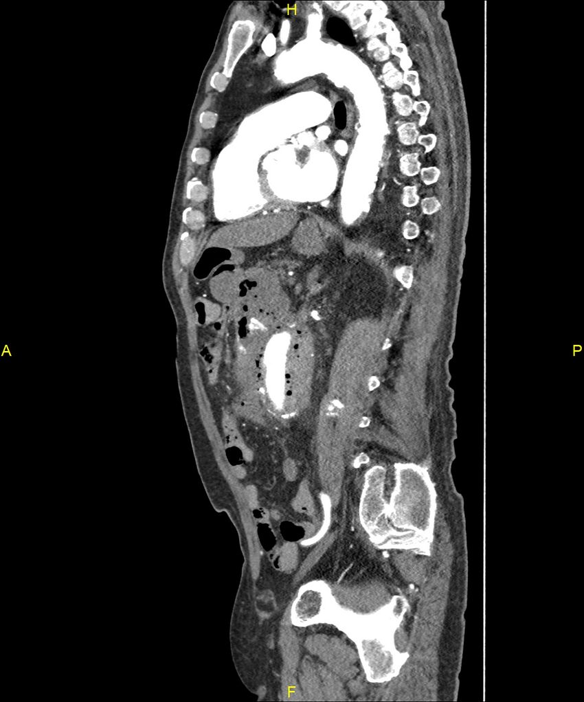 Aortoenteric fistula (Radiopaedia 84308-99603 C 208).jpg