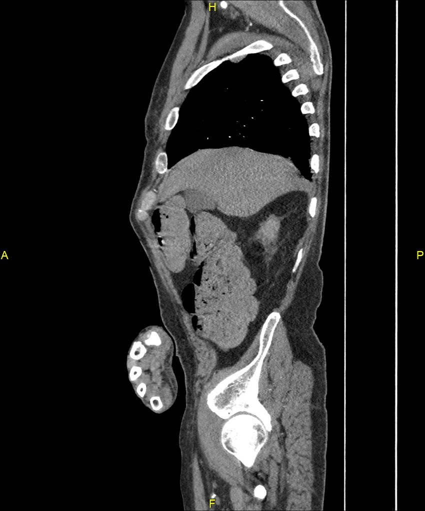 Aortoenteric fistula (Radiopaedia 84308-99603 C 70).jpg