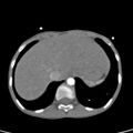 Aortopulmonary window, interrupted aortic arch and large PDA giving the descending aorta (Radiopaedia 35573-37074 B 84).jpg