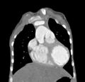 Aortopulmonary window, interrupted aortic arch and large PDA giving the descending aorta (Radiopaedia 35573-37074 D 15).jpg