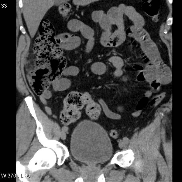 File:Appendicitis (Radiopaedia 12510-12733 Coronal non-contrast 3).jpg