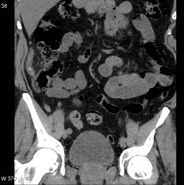 File:Appendicitis (Radiopaedia 12510-12733 Coronal non-contrast 8).jpg