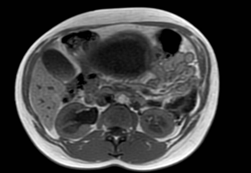 File:Appendicitis in gravida (MRI) (Radiopaedia 89433-106395 Axial T1 in-phase 25).jpg