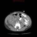 Appendicitis with phlegmon (Radiopaedia 9358-10046 A 43).jpg