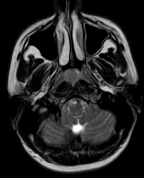 File:Arachnoid cyst- extremely large (Radiopaedia 68741-78451 Axial T2 4).jpg