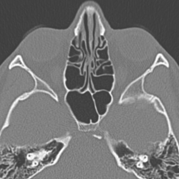 File:Arrested pneumatization of the sphenoid (Radiopaedia 10700-11172 Axial non-contrast 1).jpg