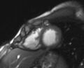 Arrhythmogenic right ventricular cardiomyopathy (Radiopaedia 69564-79464 short axis cine 63).jpg