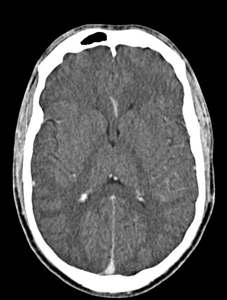 File:Arrow injury to the face (Radiopaedia 73267-84011 Axial C+ delayed 55).jpg