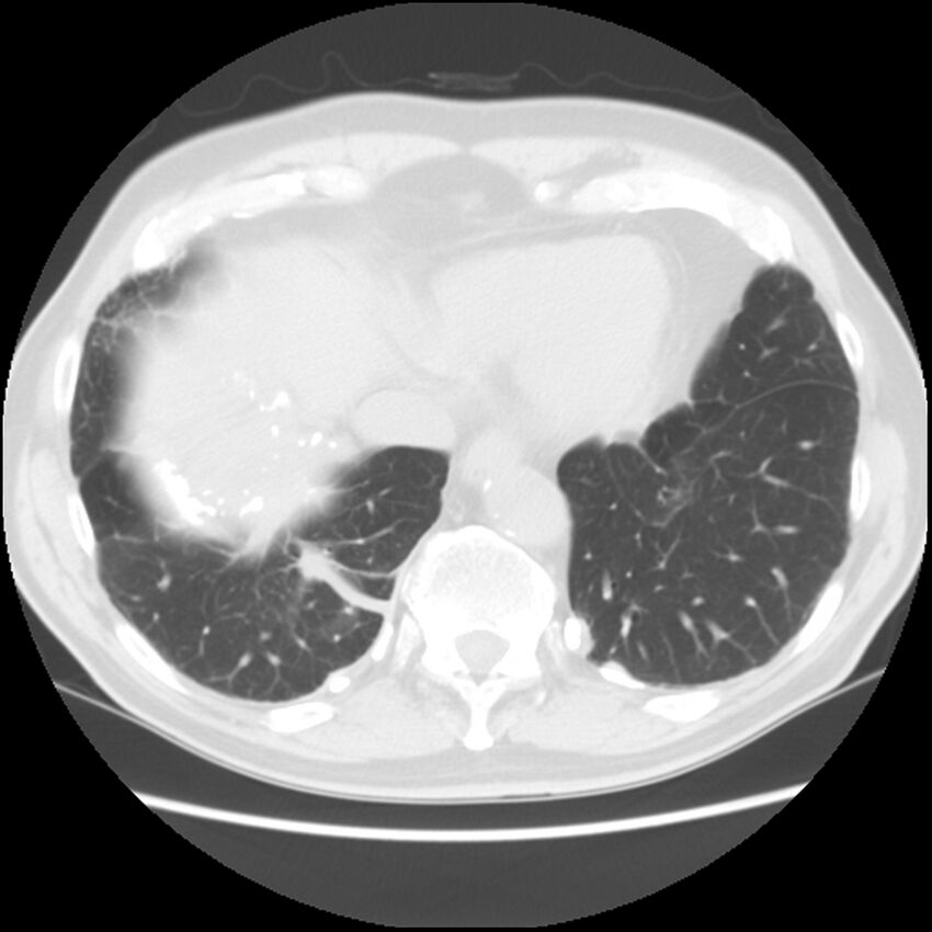 Asbestos-related pleural plaques (Radiopaedia 39069-41255 Axial lung window 57).jpg