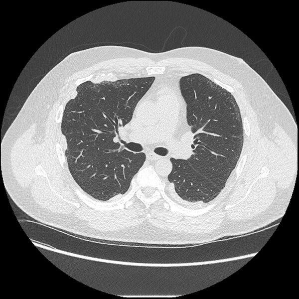 File:Asbestosis (Radiopaedia 45002-48961 Axial lung window 22).jpg