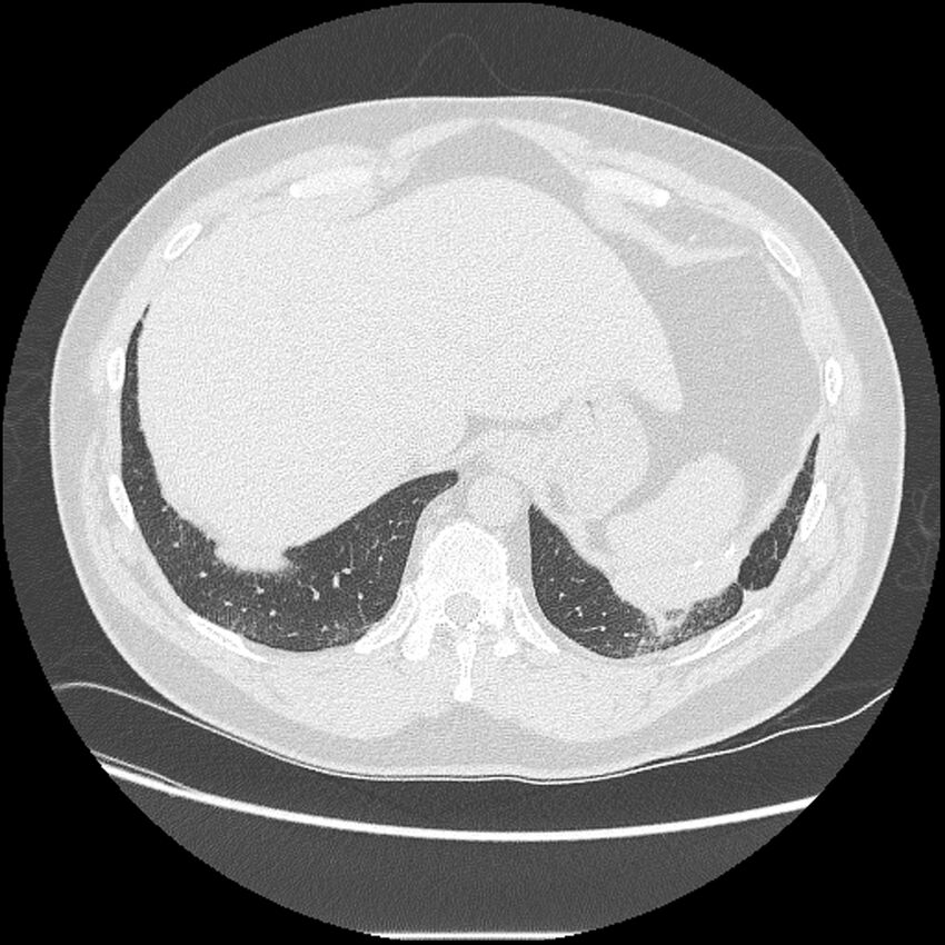 Asbestosis (Radiopaedia 45002-48961 Axial lung window 42).jpg