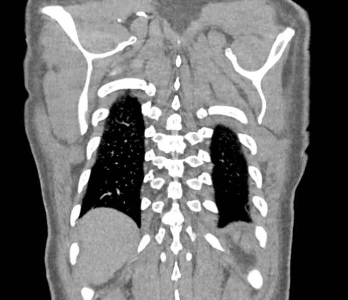 File:Ascending aortic aneurysm (Radiopaedia 86279-102297 B 59).jpg