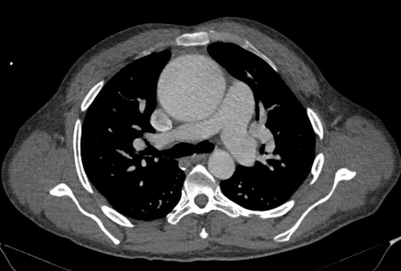 File:Ascending aortic aneurysm (Radiopaedia 86279-102297 C 21).jpg