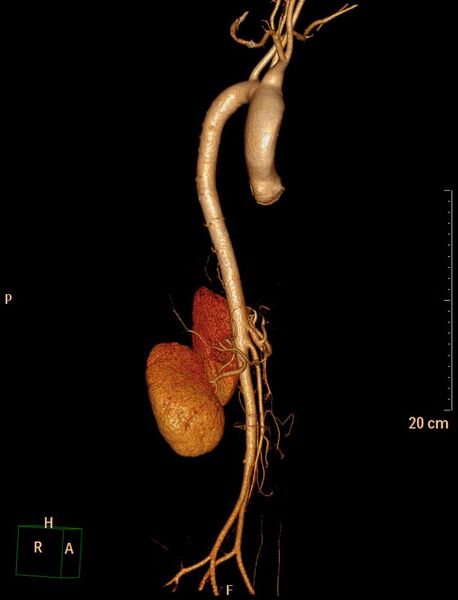 File:Ascending aortic pseudoaneurysm (Radiopaedia 28638-28910 D 6).jpg