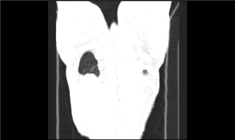 File:Aspergilloma (Radiopaedia 20788-20701 Coronal lung window 18).jpg