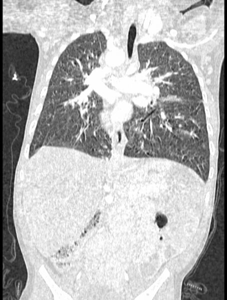File:Asplenia syndrome (Radiopaedia 73083-83792 Coronal lung window 77).jpg
