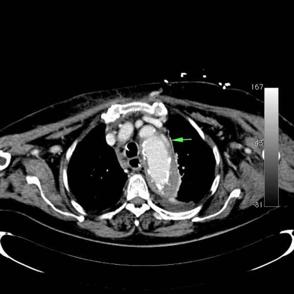 File:Atypical dissection of the thoracic aorta (Radiopaedia 10975-78320 A 9).jpg