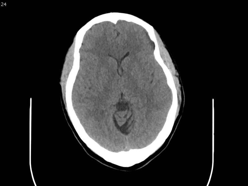 File:Atypical meningioma - intraosseous (Radiopaedia 64915-73867 A 24).jpg