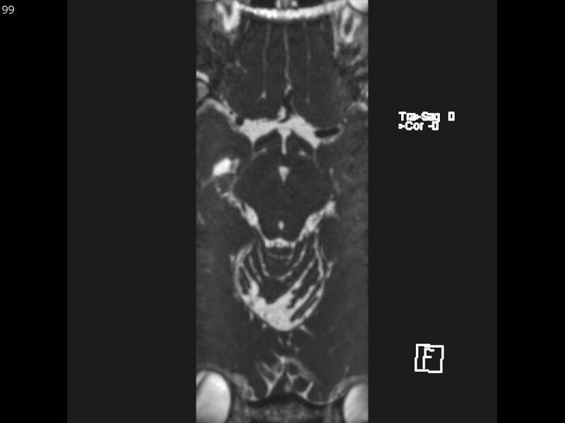 File:Atypical meningioma - intraosseous (Radiopaedia 64915-74572 Axial CISS 99).jpg