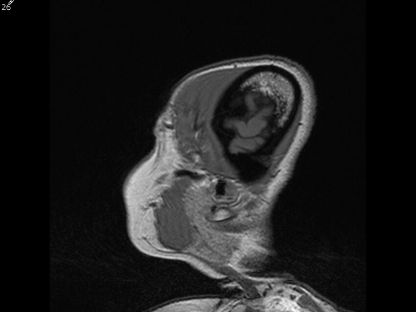Atypical meningioma - intraosseous (Radiopaedia 64915-74572 Sagittal T1 26).jpg