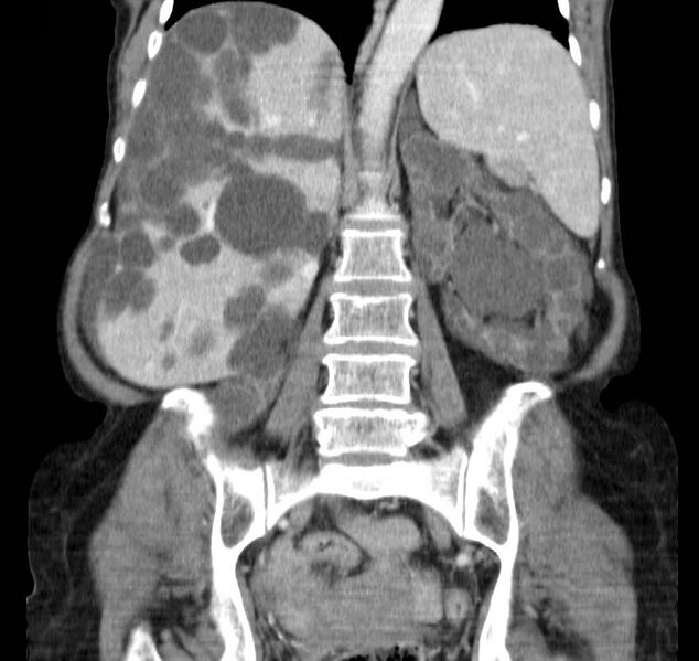 File:Autosomal dominant polycystic kidney disease (Radiopaedia 16777-16490 B 31).jpg