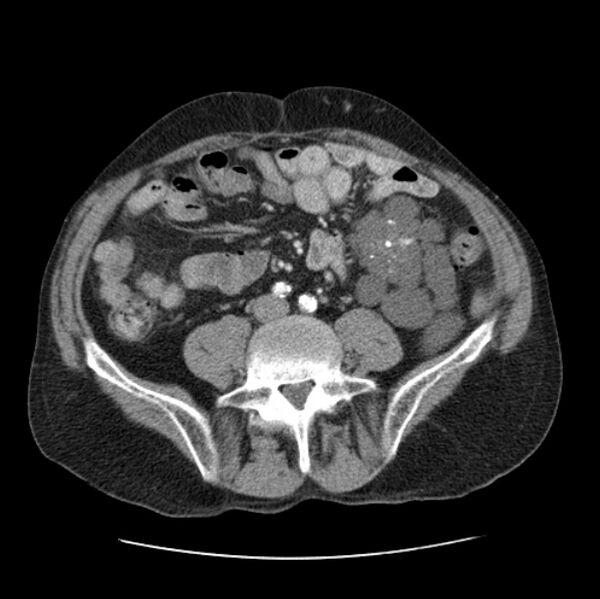 File:Autosomal dominant polycystic kidney disease (Radiopaedia 27851-28094 B 87).jpg
