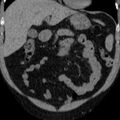Autosomal dominant polycystic kidney disease (Radiopaedia 36539-38101 Coronal non-contrast 1).jpg