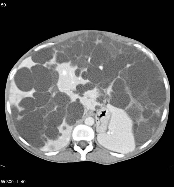 File:Autosomal dominant polycystic kidney disease with extensive hepatic involvement (Radiopaedia 5204-6971 B 6).jpg