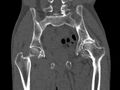 Avascular necrosis of the left hip (Radiopaedia 75068-86125 Coronal bone window 43).jpg