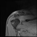 Avulsion fracture - greater tuberosity of humerus (Radiopaedia 71216-81515 Coronal T2 8).jpg